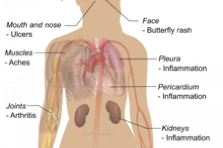 Symptoms of Lupus