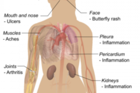 Symptoms of Lupus