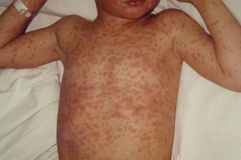 Symtoms of Measles
