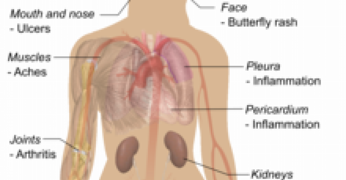 Symptoms of Lupus
