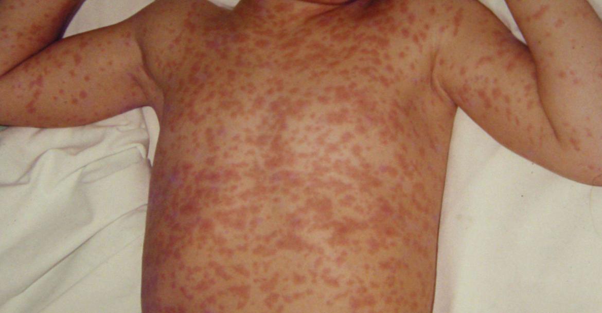 Symtoms of Measles